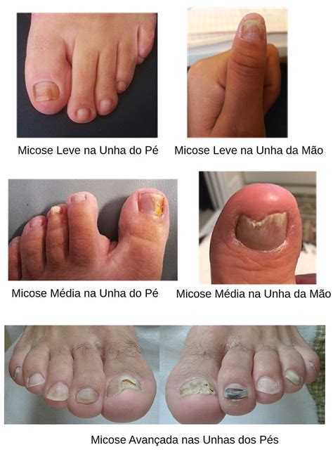 O Que Causa Micose Na Unha - Micose nas unhas, fungo nas unhas ou fungo verde nas unhas: o que é ...