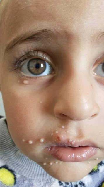 molluscum contagiosum  face molluscum contagiosum wikipedia