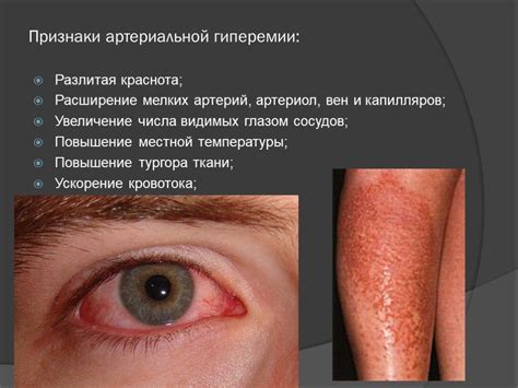 Презентация "Артериальная гиперемия" – скачать проект