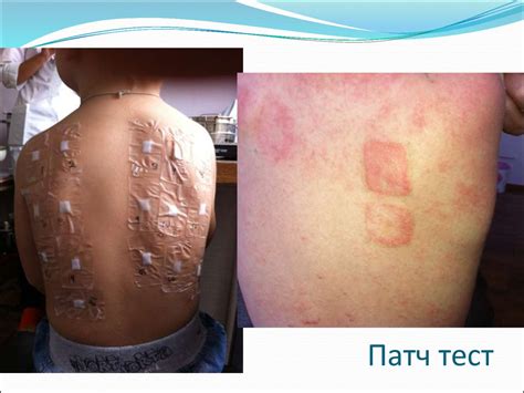 Харчова алергія у дітей з позиції доказової медицини - презентация онлайн