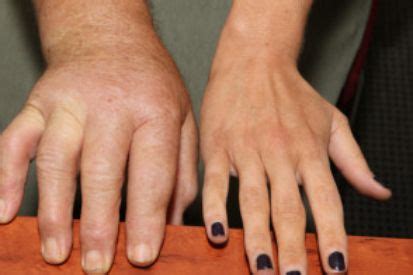 scleroderma symptoms  treatment lupton dermatology