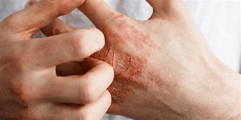 Atopic Dermatitis Treatments | SLO, CA | Coastal Dermatology