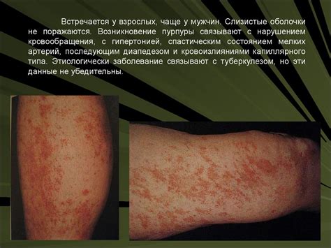 Васкулиты кожи - презентация онлайн