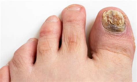 How to Identify Fungal Nail Infections - ELMENS