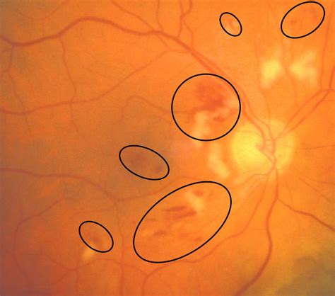 Intraretinal Hemorrhage