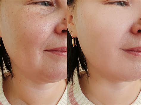 Enrugar Ou Enrrugar - Foto de Mulher Enrugar Antes E Depois Da Colagem Tratamento e mais ...