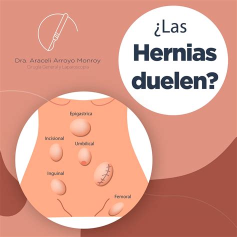 ¿Las hernias duelen?🤔 👩‍⚕️💬No siempre. Existen hernias que no producen