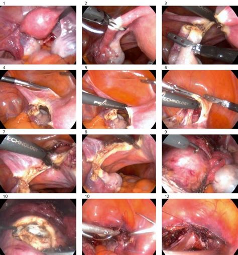 Laparoscopic hysterectomy procedure: pelvic cavity prior to surgery ...