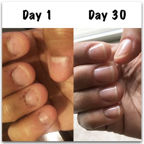 Nail Biting Damage Repair - Nail Ftempo