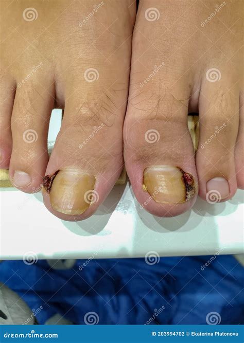 Close-up of Toes, Ingrown Toenail Problem, Beginning of Healing of an