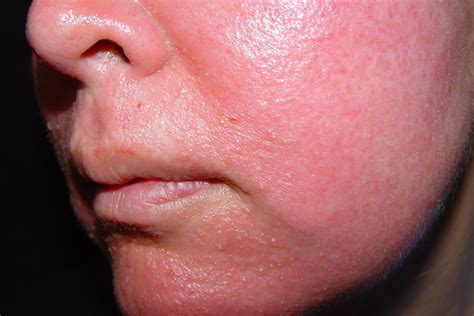 dermatitis por rhus en la  todo acerca de la dermatitis atopica