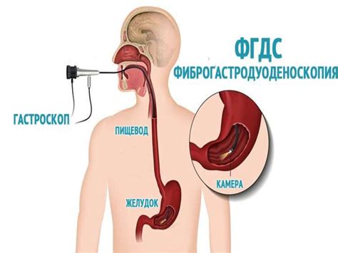 Фиброгастродуоденоскопия әдісі - презентация онлайн