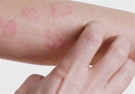 Que Que É Dermatite - Dermatite - O que é, sintomas, tipos da doença e como tratar