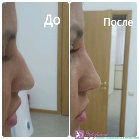 Безоперационная ринопластика носа