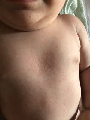 Bolinhas De Calor No Corpo Do Bebe - Bolinhas pelo corpo | BabyCenter