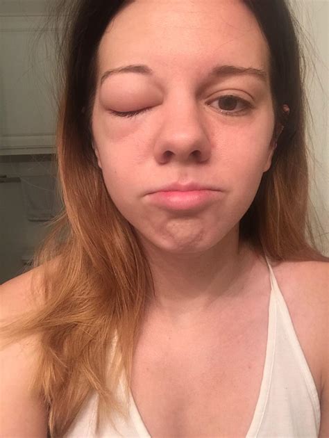 Hereditary Angioedema