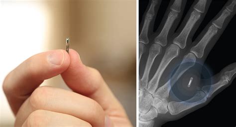 Why are people inserting Microchips into their body? | by Owen Barker ...