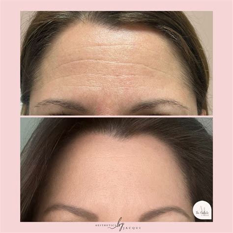 NEUROTOXIN (BOTOX) | Rejuv Aesthetics & Wellness Spa