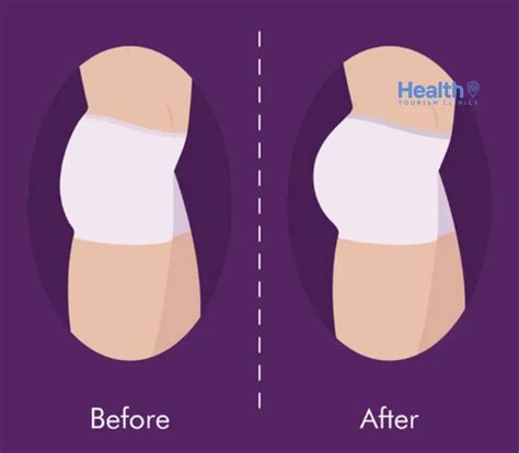 brazilian butt lift bbl  turkey  price review clinics