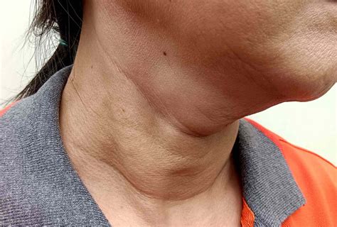 Swollen Neck Thyroid