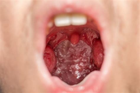 ᐈ Tonsils stock pictures, Royalty Free tonsil images | download on Depositphotos®