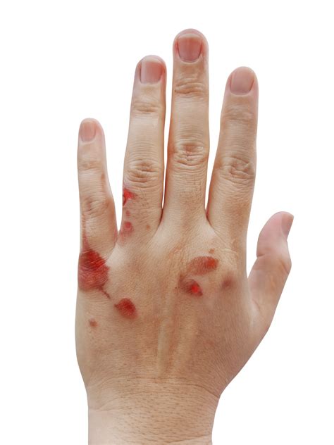 Hands with blisters from heat PNG transparent 33300192 PNG