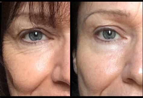 Fascia Blaster Before And After Face - www.inf-inet.com