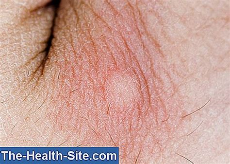 Insect Bite Inflammation: Possible Complications 💊 Scientific-Practical ...