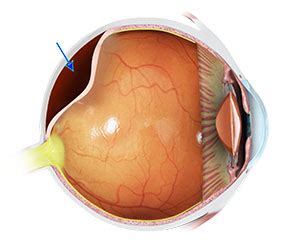 Posterior Vitreous Detachment Huntington Beach | Retinal Tear | Eye ...