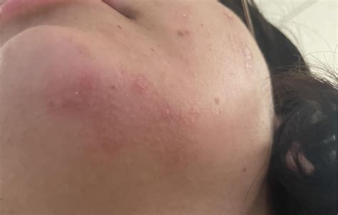 [Trigger Warning] Potential allergic reaction to Himalayan salt? Or is