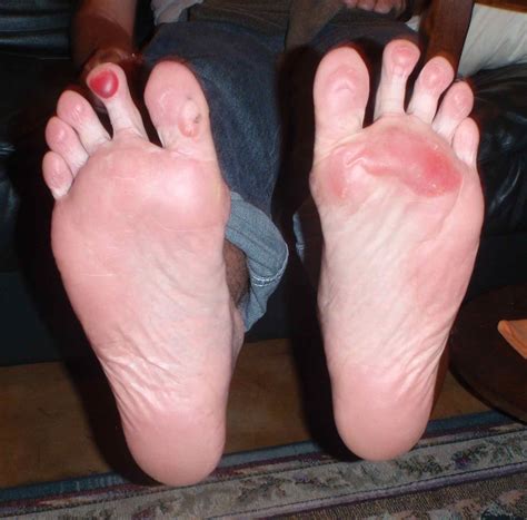 Feet Blisters From Hot Concrete at Ilene Haase blog