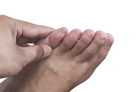 Foot Blisters: Causes, Treatment, and Prevention - Howard County Foot ...