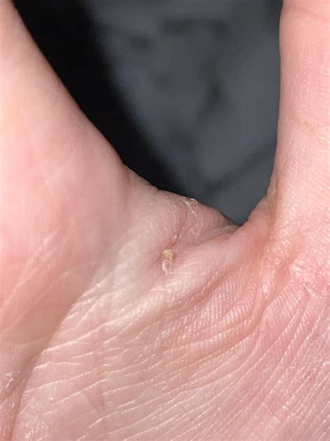 Post scabies burrow? : r/scabies