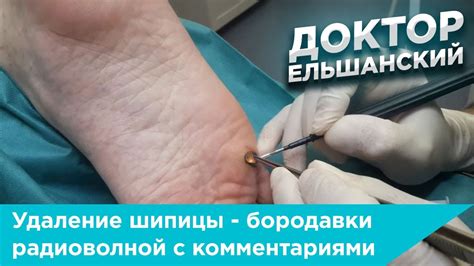 Удаление шипицы - бородавки радиоволной с комментариями врача - YouTube