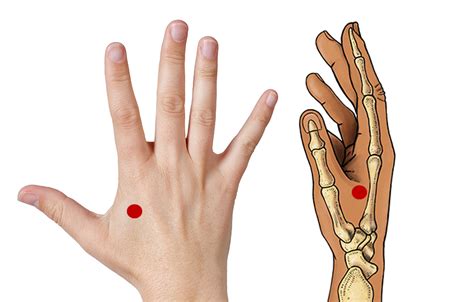 acupressure  neck pain  doctor