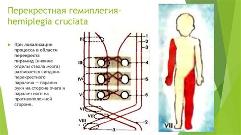 Синдромы поражения головного мозга - online presentation