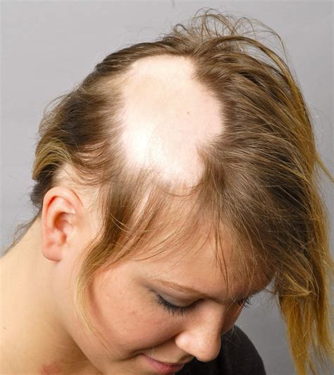 alopecia areata hair loss   treatment options home