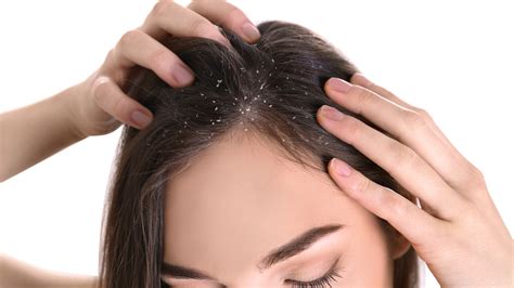 How To Tell If You Have Scalp Psoriasis Vs. Dandruff
