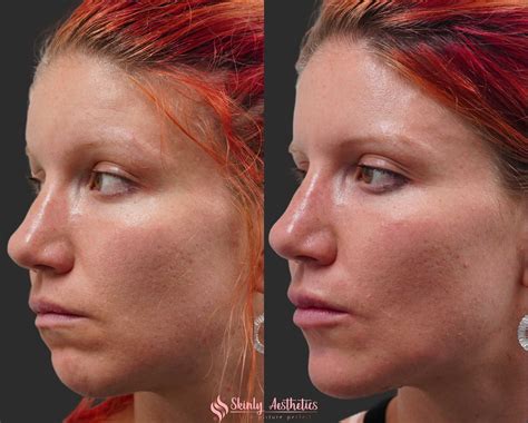 before and after fillers face 1