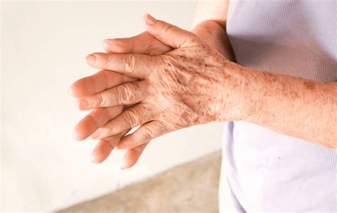 age spots  treatments aesthetics life