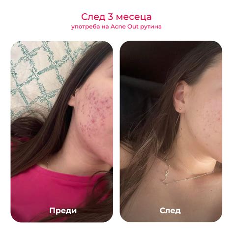 Acne Out активен лосион против пъпки