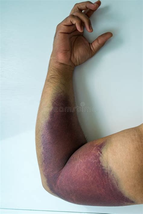 Bicep Tear or Strain, Tendon Injuries on a Muscular Man Hand. Trauman