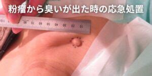 粉瘤から臭いが出たときの応急処置｜自宅でできる対処と根本治療を解説 | 東京皮膚のできものと粉瘤クリニック ふるばやし形成外科 新宿院