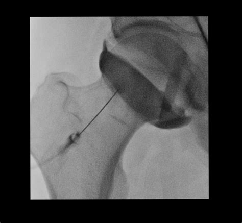 arthrogram | pacs