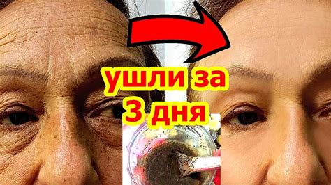 УБРАЛА за 3 Дня Морщины на Лбу Межбровную Морщину Маска от морщин для ...