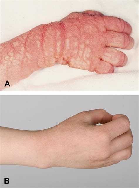 ichthyosis prematurity syndrome   defined congenital ichthyosis