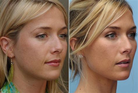 Контурная пластика лица | Botox, Plastic surgery, Cosmetic surgery
