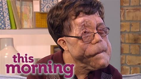 Pictures of Adam Pearson