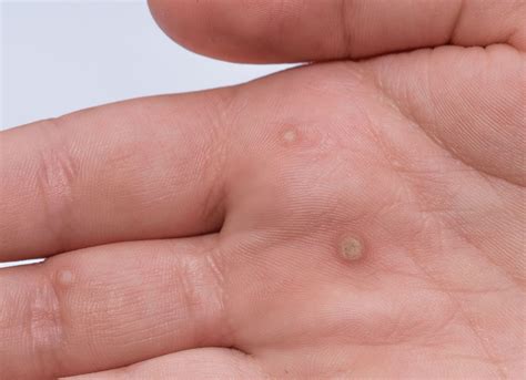 Warts | Fungal Skin Infections | Viral Skin Infections