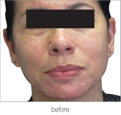 Before After | Skin Space